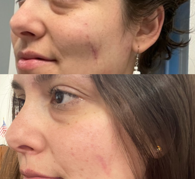 4 Sessions Nano Fusion with Perfecting Serum for Birth Mark Removal Deep Scar